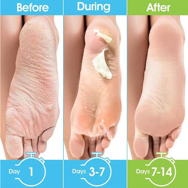 1 Pacote = 1 Par de Máscara de - Foot Mask Peeling avaliação e preço