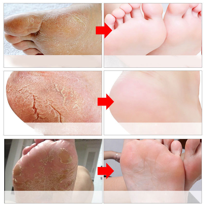 Máscaras esfoliantes para os p - Foot Mask Peeling avaliação e preço